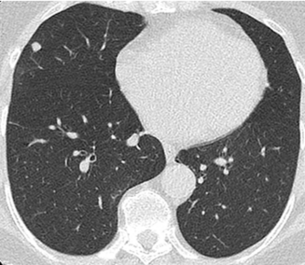 zufällig entdeckter Rundherd
