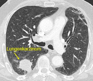 Lungenkarzinom