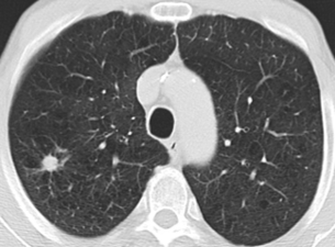 zufällig entdecktes Lungenkarzinom