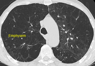 Lungenemphysem