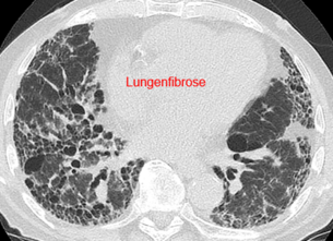 Lungenfibrose