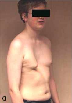 Trichterbrust frauen